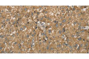 Immunohistochemistry of paraffin-embedded Human liver cancer using SDHB Polyclonal Antibody at dilution of 1:30 (SDHB antibody)