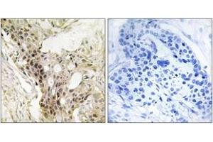 Immunohistochemistry analysis of paraffin-embedded human breast carcinoma tissue, using MED21 Antibody. (MED21 antibody  (AA 71-120))