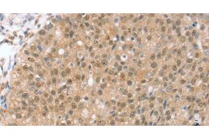Immunohistochemistry of paraffin-embedded Human breast cancer using TRIM35 Polyclonal Antibody at dilution of 1:35 (TRIM35 antibody)