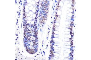 Immunohistochemistry of paraffin-embedded human colon using Snail Rabbit pAb (ABIN6134928, ABIN6148176, ABIN6148179 and ABIN6215911) at dilution of 1:100 (40x lens). (SNAIL antibody  (C-Term))