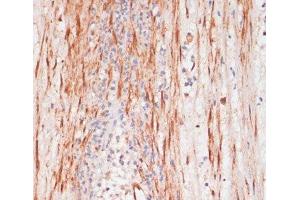 Immunohistochemistry of paraffin-embedded Human appendix using Phospho-PEA15(S104) Polyclonal Antibody at dilution of 1:100 (40x lens). (PEA15 antibody  (pSer104))