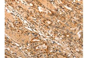 The image on the left is immunohistochemistry of paraffin-embedded Human gastic cancer tissue using ABIN7189699(ADRA1B Antibody) at dilution 1/20, on the right is treated with synthetic peptide. (ADRA1B antibody)