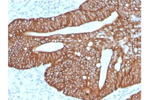 Formalin-fixed, paraffin-embedded human Colon Carcinoma stained with Cytokeratin 18Rabbit Recombinant Monoclonal Antibody (KRT18/2819R). (Recombinant Cytokeratin 18 antibody)