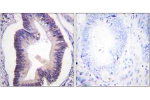 Immunohistochemistry analysis of paraffin-embedded human colon carcinoma tissue, using PFKFB2 (Ab-483) Antibody. (PFKFB2 antibody  (AA 451-500))