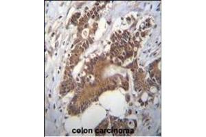 PCYT1A Antibody (N-term) (ABIN656103 and ABIN2845445) immunohistochemistry analysis in formalin fixed and paraffin embedded human colon carcinoma followed by peroxidase conjugation of the secondary antibody and DAB staining. (PCYT1A antibody  (N-Term))