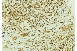 ABIN6269322 at 1/100 staining Human breast cancer tissue by IHC-P.
