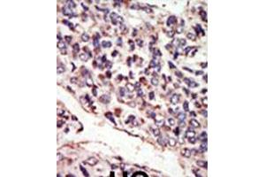 Formalin-fixed and paraffin-embedded human cancer tissue reacted with the primary antibody, which was peroxidase-conjugated to the secondary antibody, followed by DAB staining. (NTRK3 antibody  (N-Term))