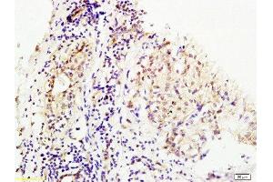Formalin-fixed and human breast carcinoma tissue labeled with Anti-MMS19 Polyclonal Antibody, Unconjugated at 1:200 followed by conjugation to the secondary antibody and DAB staining