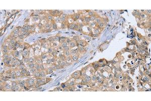 Immunohistochemistry of paraffin-embedded Human breast cancer using CYTH1 Polyclonal Antibody at dilution of 1:40