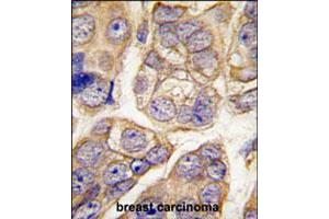 Formalin-fixed and paraffin-embedded human breast carcinoma tissue reacted with CDH13 polyclonal antibody  , which was peroxidase-conjugated to the secondary antibody, followed by DAB staining. (Cadherin 13 antibody  (C-Term))
