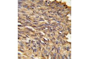 Immunohistochemistry in formalin-fixed and paraffin-embedded human lung carcinoma reacted with Vigilin / HDLBP Antibody (Center) followed which was peroxidase-conjugated to the secondary antibody, followed by DAB staining. (HDLBP antibody  (Middle Region))