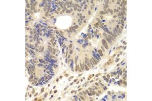Immunohistochemistry of paraffin-embedded human colon carcinoma using LHX4 antibody at dilution of 1:100 (x400 lens).