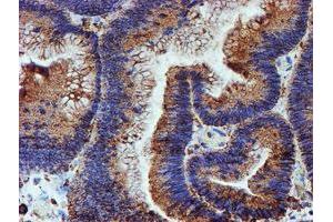 Immunohistochemical staining of paraffin-embedded Adenocarcinoma of Human colon tissue using anti-PDIA4 mouse monoclonal antibody. (PDIA4 antibody)