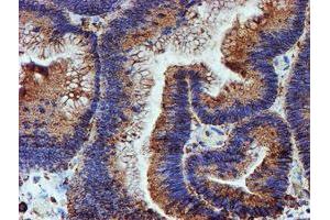 Immunohistochemical staining of paraffin-embedded Adenocarcinoma of Human colon tissue using anti-PDIA4 mouse monoclonal antibody.