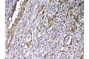 IHC testing of FFPE human rectal cancer tissue with VDBP antibody at 1ug/ml.