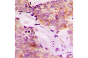 Immunohistochemical analysis of MRPS32 staining in human breast cancer formalin fixed paraffin embedded tissue section. (MRPL42 antibody  (Center))