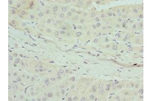 Immunohistochemistry of paraffin-embedded human liver cancer using ABIN7144441 at dilution of 1:100 (Apolipoprotein M antibody  (AA 23-188))