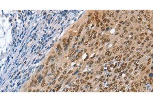 Immunohistochemistry of paraffin-embedded Human cervical cancer using MCM6 Polyclonal Antibody at dilution of 1:45 (MCM6 antibody)