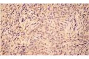 Immunohistochemistry analysis of human breast cancer tissue with HO-2 pAb. (HMOX2 antibody  (N-Term))