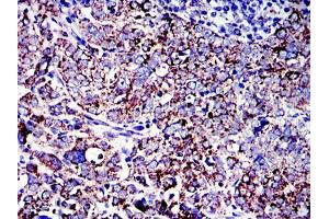 Immunohistochemical analysis of paraffin-embedded human cervical cancer tissues using AIF mouse mAb with DAB staining. (AIF antibody)