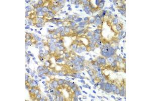 Immunohistochemistry of paraffin-embedded human gastric cancer using TFAM antibody at dilution of 1:100 (x40 lens). (TFAM antibody)