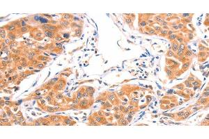 Immunohistochemistry of paraffin-embedded Human lung cancer using AMPD1 Polyclonal Antibody at dilution of 1:80 (AMPD1 antibody)