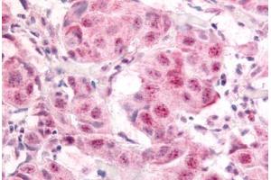 Human Breast Carcinoma (formalin-fixed, paraffin-embedded) stained with E2F1 antibody ABIN214450 at 10 ug/ml followed by biotinylated goat anti-rabbit IgG secondary antibody ABIN481713, alkaline phosphatase-streptavidin and chromogen. (E2F1 antibody  (pSer364))