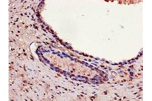 Immunohistochemistry of paraffin-embedded human prostate cancer using ABIN7154138 at dilution of 1:100 (GAPDH antibody  (AA 3-335))
