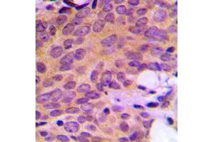 Immunohistochemical analysis of Ataxin 2 staining in human breast cancer formalin fixed paraffin embedded tissue section. (Ataxin 2 antibody  (Center))