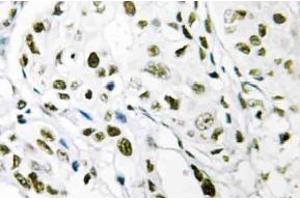 Immunohistochemistry (IHC) analyzes of Elongin A1 antibody in paraffin-embedded human breast carcinoma tissue.