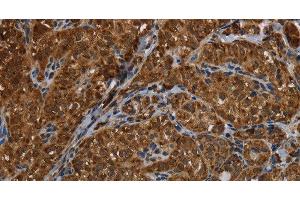Immunohistochemistry of paraffin-embedded Human thyroid cancer using HSD17B13 Polyclonal Antibody at dilution of 1:30 (HSD17B13 antibody)
