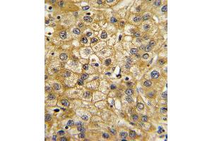 Formalin-fixed and paraffin-embedded human hepatocarcinoma with ADIPOR1 Antibody (C-term), which was peroxidase-conjugated to the secondary antibody, followed by DAB staining.
