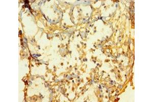 Immunohistochemistry of paraffin-embedded human breast cancer using ABIN7165112 at dilution of 1:100