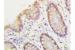 Formalin-fixed and paraffin embedded human colon carcinoma labeled with Anti-HMGA1/HMG-I/HMG-Y Polyclonal Antibody, Unconjugated  at 1:200 followed by conjugation to the secondary antibody and DAB staining. (HMGA1 antibody  (AA 51-107))