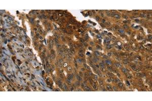 Immunohistochemistry of paraffin-embedded Human cervical cancer using PPIA Polyclonal Antibody at dilution of 1:35 (PPIA antibody)