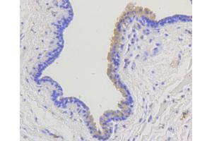 Immunohistochemistry of paraffin-embedded human mammary cancer using ARRB1 antibody (ABIN5996907) at dilution of 1/100 (40x lens). (beta Arrestin 1 antibody)