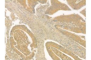 ABIN6265876 and ABIN6276800 at 1/100 staining human colon carcinoma by IHC-P. (UGT1A9 antibody  (C-Term))