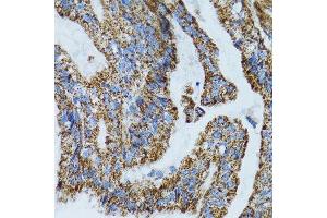 Immunohistochemistry of paraffin-embedded human gastric cancer using MRPL28 antibody. (MRPL28 antibody  (AA 1-256))