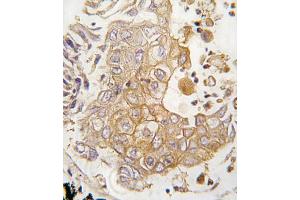Formalin-fixed and paraffin-embedded human lung carcinoma tissue reacted with CYP1A1 antibody (C-term), which was peroxidase-conjugated to the secondary antibody, followed by DAB staining. (CYP1A1 antibody  (C-Term))