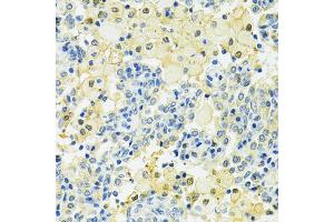 Immunohistochemistry of paraffin-embedded human lung cancer using SLC25A1 antibody (ABIN4905187) at dilution of 1:100 (40x lens).