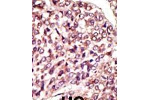 Formalin-fixed and paraffin-embedded human cancer tissue reacted with the primary antibody, which was peroxidase-conjugated to the secondary antibody, followed by AEC staining. (MGAT1 antibody  (C-Term))
