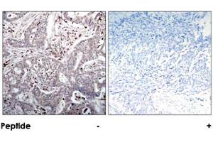 Immunohistochemical analysis of paraffin-embedded human breast carcinoma tissue using NFKBIB polyclonal antibody . (NFKBIB antibody)
