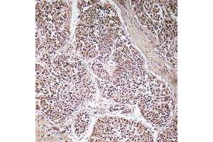 Immunohistochemical analysis of ATP5C1 staining in human liver cancer formalin fixed paraffin embedded tissue section.