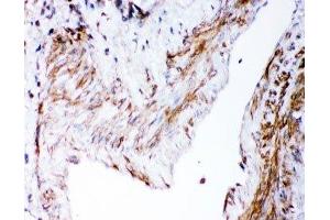 IHC-P: DHFR antibody testing of human lung cancer tissue (Dihydrofolate Reductase antibody  (AA 2-187))