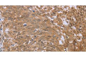 Immunohistochemistry of paraffin-embedded Human cervical cancer using FHL2 Polyclonal Antibody at dilution of 1:40 (FHL2 antibody)