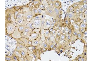 Immunohistochemistry of paraffin-embedded human breast cancer using PDE4D antibody (ABIN3022336, ABIN3022337, ABIN3022338 and ABIN6218749) at dilution of 1:100 (40x lens). (PDE4D antibody  (AA 249-518))