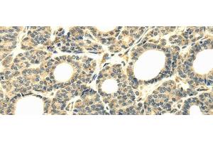Immunohistochemistry of paraffin-embedded Human thyroid cancer tissue using WDR45B Polyclonal Antibody at dilution 1:40 (WD Repeat Domain 45B (WDR45B) antibody)