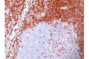 Formalin-fixed, paraffin-embedded human Non-Hodgkin's Lymphoma stained with Bcl-2 Mouse Monoclonal Antibody (SPM117). (Bcl-2 antibody  (AA 41-54))
