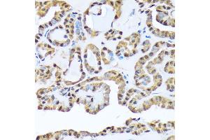 Immunohistochemistry of paraffin-embedded human thyroid cancer using FKBP51/FKBP5 Rabbit mAb (ABIN7267213) at dilution of 1:100 (40x lens). (FKBP5 antibody)
