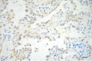 Immunohistochemistry was performed on paraffin-embedded human lung adenocarcinoma using phospho-beta arrestin 1 (S412) antibody (ABIN7797654), 1:200).
